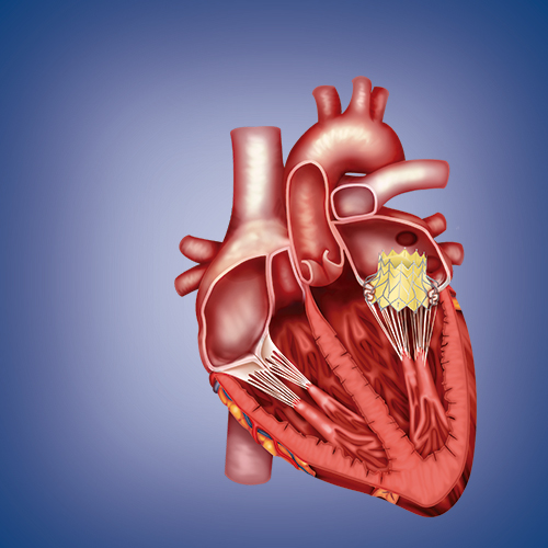 CardiAQ Valve Technologies v. Neovasc