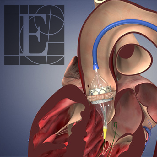 Edwards Lifesciences v. CoreValve