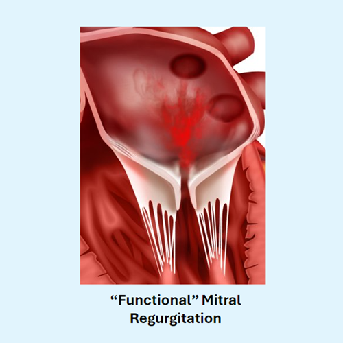 Femoral Catheterization and Delivery