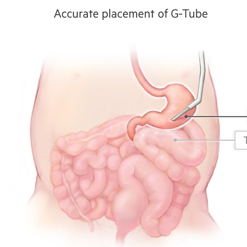 Fetal Gastronomy Tube Misplacement