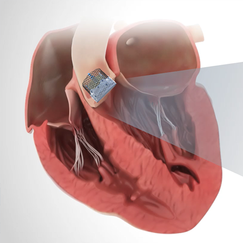 Artificial Aortic Valve Structure