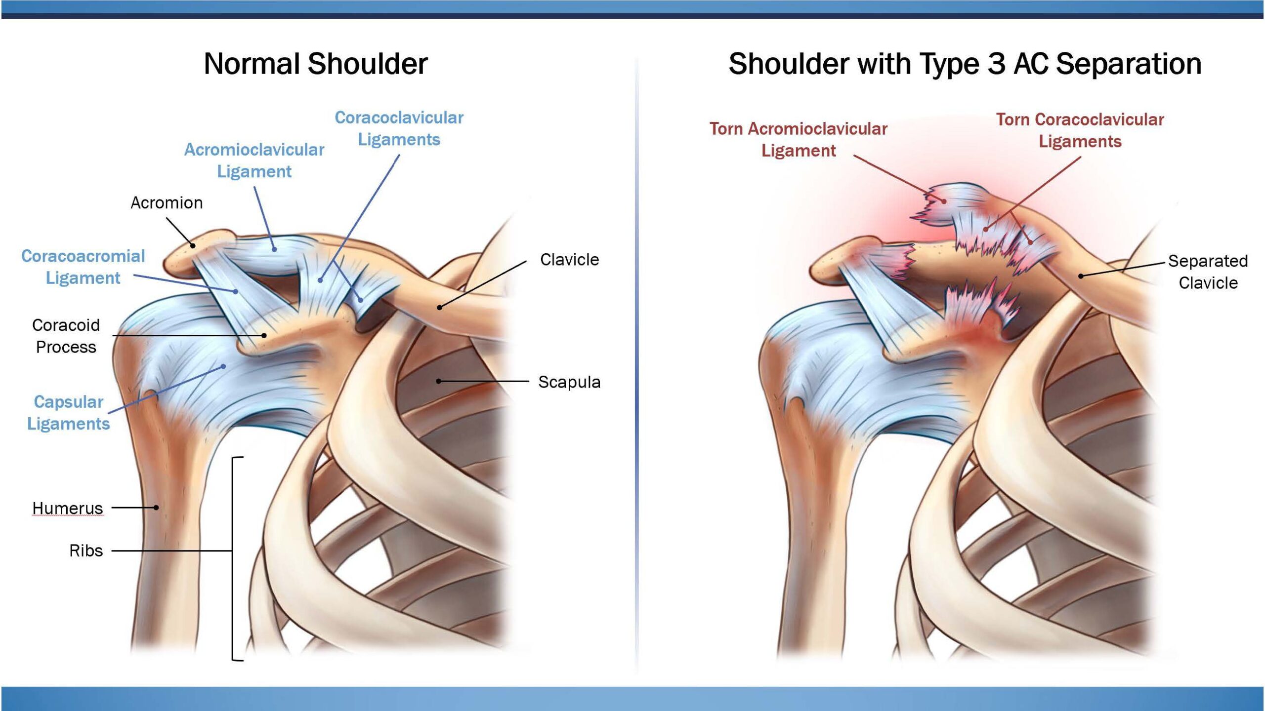 AC Joint Separation
