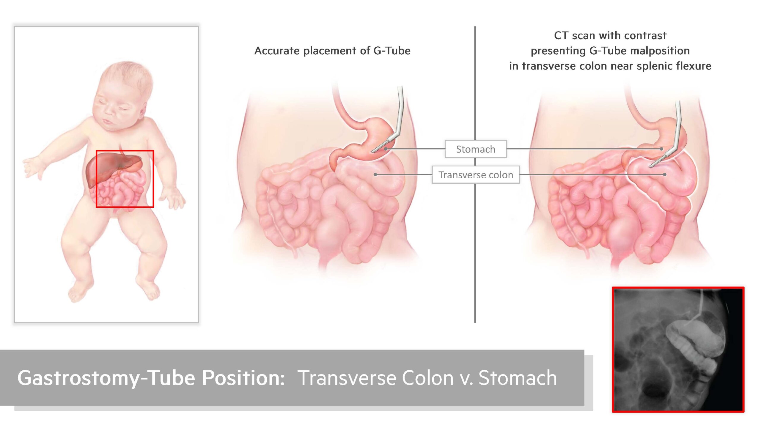 Fetal Gastronomy Tube Misplacement